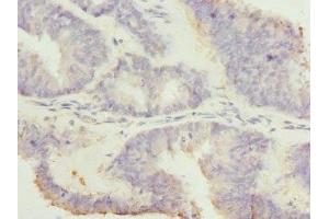 Immunohistochemistry of paraffin-embedded human endometrial cancer using ABIN7167620 at dilution of 1:100 (RGS7 抗体  (AA 1-300))