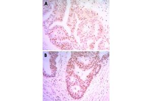 Immunohistochemical analysis of paraffin-embedded human colon cancer tissue (A) and ovary cancer tissue (B) using THAP11 monoclonal antobody, clone 3F3  with DAB staining. (THAP11 抗体)