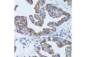 Immunohistochemistry of paraffin-embedded human gastric cancer using GIP antibody (ABIN1882357) at dilution of 1:100 (40x lens). (GIP 抗体)