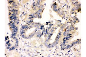 Anti-Caspase-7(P11) antibody, IHC(P) IHC(P): Human Intestinal Cancer Tissue (Caspase 7 抗体  (Middle Region))