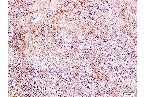 Formalin-fixed and paraffin embedded rat colon carcinoma labeled with Anti-Slc22A17 Y Polyclonal Antibody, Unconjugated (ABIN668691) at 1:300, followed by conjugation to the secondary antibody and DAB staining