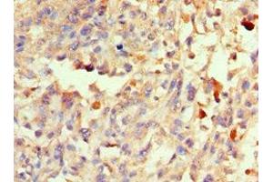 Immunohistochemistry of paraffin-embedded human melanoma using ABIN7166082 at dilution of 1:100 (40S Ribosomal Protein S3-B (RPS3.S) (AA 1-92) 抗体)