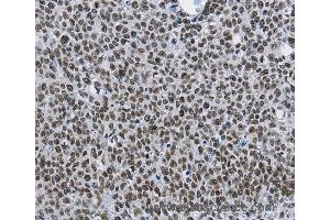 Immunohistochemistry of Human colon cancer using CMTM2 Polyclonal Antibody at dilution of 1:60 (CMTM2 抗体)