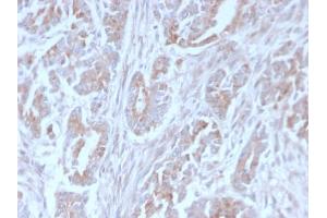 Formalin-fixed, paraffin-embedded human Colon Carcinoma stained with ICOS-L Mouse Monoclonal Antibody (ICOSL/3111). (ICOSLG 抗体  (AA 23-149))