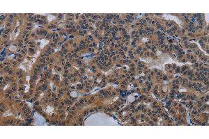 Immunohistochemistry of paraffin-embedded Human thyroid cancer tissue using INSIG2 Polyclonal Antibody at dilution 1:30 (INSIG2 抗体)