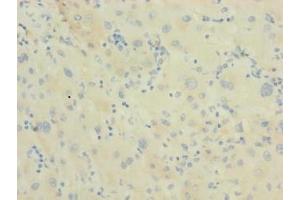 Immunohistochemistry of paraffin-embedded human liver cancer using ABIN7150510 at dilution of 1:100 (DNAJB14 抗体  (AA 1-244))