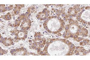 ABIN6272771 at 1/100 staining Human liver cancer tissue by IHC-P. (OR4N2 抗体)