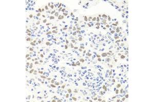 Immunohistochemistry of paraffin-embedded human esophageal cancer using EXO1 antibody (ABIN6129824, ABIN6140356, ABIN6140357 and ABIN6219087) at dilution of 1:100 (40x lens). (Exonuclease 1 抗体  (AA 601-846))