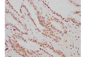 IHC image of ABIN7127344 diluted at 1:183 and staining in paraffin-embedded human prostate cancer performed on a Leica BondTM system. (Recombinant ARNT 抗体)