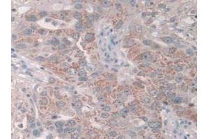 IHC-P analysis of Human Breast Cancer Tissue, with DAB staining. (GRB10 抗体  (AA 392-594))