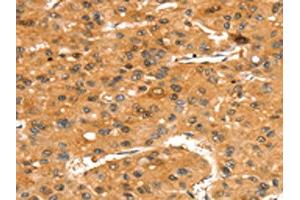 The image on the left is immunohistochemistry of paraffin-embedded Human liver cancer tissue using ABIN7192437(SLC24A4 Antibody) at dilution 1/35, on the right is treated with synthetic peptide. (SLC24A4 抗体)