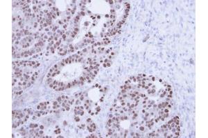 IHC-P Image Immunohistochemical analysis of paraffin-embedded NCIN87 Xenograft , using TAP , antibody at 1:100 dilution. (NXF1 抗体  (N-Term))