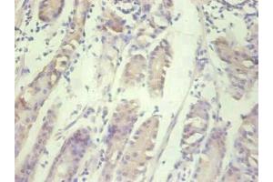 Immunohistochemical of paraffin-embedded human gastric cancer tissue using ABIN7156932 at dilution of 1:200.