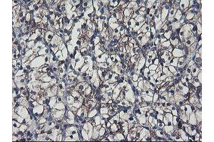 Immunohistochemical staining of paraffin-embedded Carcinoma of Human kidney tissue using anti-SH2D2A mouse monoclonal antibody. (SH2D2A 抗体)