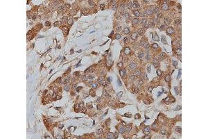 ABIN6279217 at 1/200 staining human lymphoma tissue sections by IHC-P. (slc25a13 抗体  (C-Term))