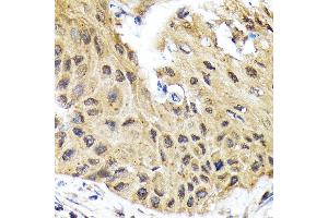 Immunohistochemistry of paraffin-embedded human lung cancer using eIF2B epsilon (EIF2B5) (EIF2B5) Rabbit mAb (ABIN7267038) at dilution of 1:100 (40x lens).