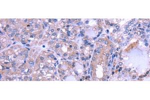 Immunohistochemistry of paraffin-embedded Human thyroid cancer using THRSP Polyclonal Antibody at dilution of 1/30 (THRSP 抗体)