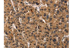 The image on the left is immunohistochemistry of paraffin-embedded Human liver cancer tissue using ABIN7190461(DEFA5 Antibody) at dilution 1/15, on the right is treated with synthetic peptide. (DEFA5 抗体)