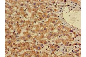 Immunohistochemistry of paraffin-embedded human liver cancer using ABIN7155691 at dilution of 1:100 (EN2 抗体  (AA 1-251))