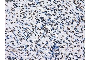 Immunohistochemical staining of paraffin-embedded Adenocarcinoma of breast tissue using anti-ID3 mouse monoclonal antibody. (ID3 抗体)