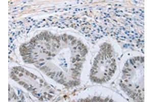 The image on the left is immunohistochemistry of paraffin-embedded Human colon cancer tissue using ABIN7191633(NEUROG2 Antibody) at dilution 1/15, on the right is treated with synthetic peptide. (Neurogenin 2 抗体)