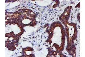 Immunohistochemical staining of paraffin-embedded Adenocarcinoma of Human colon tissue using anti-MEF2C mouse monoclonal antibody. (MEF2C 抗体)