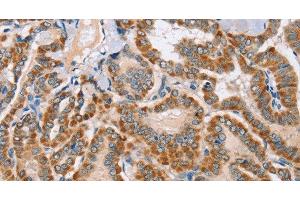 Immunohistochemistry of paraffin-embedded Human thyroid cancer using MSMB Polyclonal Antibody at dilution of 1:30 (MSMB 抗体)