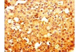 Immunohistochemistry of paraffin-embedded human breast cancer using ABIN7151123 at dilution of 1:100 (RNF13 抗体  (AA 432-685))