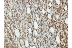 Immunoperoxidase of monoclonal antibody to EIF5 on formalin-fixed paraffin-embedded human malignant lymphoma, diffuse large B tissue. (EIF5 抗体  (AA 1-431))