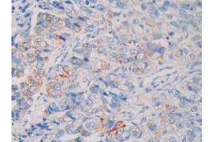 IHC-P analysis of Human Breast Cancer Tissue, with DAB staining. (MME 抗体  (AA 382-538))