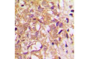 Immunohistochemical analysis of TIMP2 staining in human breast cancer formalin fixed paraffin embedded tissue section. (TIMP2 抗体  (Center))