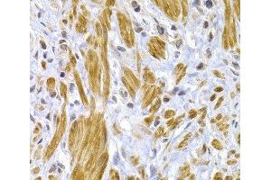 Immunohistochemistry of paraffin-embedded Human gastric cancer using Desmoplakin Polyclonal Antibody at dilution of 1:100 (40x lens).