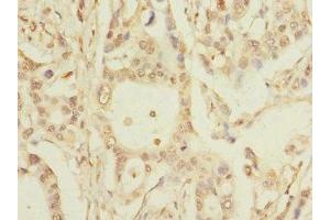 Immunohistochemistry of paraffin-embedded human pancreatic cancer using ABIN7163816 at dilution of 1:100 (PKD2L2 抗体  (AA 390-523))