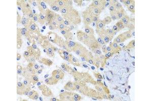Immunohistochemistry of paraffin-embedded Human liver damage using ABCB8 Polyclonal Antibody at dilution of 1:100 (40x lens).