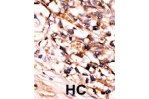 Formalin-fixed and paraffin-embedded human hepatocellular carcinoma tissue reacted with MAPKAPK5 (phospho S93) polyclonal antibody  which was peroxidase-conjugated to the secondary antibody followed by DAB staining. (MAPKAP Kinase 5 抗体  (pSer93))