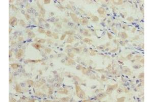 Immunohistochemistry of paraffin-embedded human gastric cancer using ABIN7153839 at dilution of 1:100 (GCSAML 抗体  (AA 1-135))