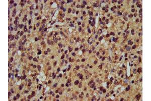 IHC image of ABIN7164940 diluted at 1:400 and staining in paraffin-embedded human glioma performed on a Leica BondTM system. (POMP 抗体  (AA 1-141))