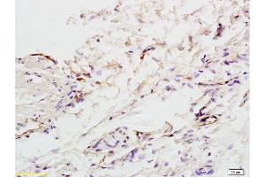 Formalin-fixed and paraffin embedded:human colon carcinoma labeled with Anti-factor VIII(FVIII)(human) Polyclonal Antibody , Unconjugated at 1:200, followed by conjugation to the secondary antibody and DAB staining (Factor VIII 抗体  (AA 1451-1550))