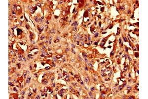 Immunohistochemistry analysis of human melanoma using ABIN7145741 at dilution of 1:100 (BCAT1 抗体  (AA 4-276))