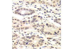 Immunohistochemistry of paraffin-embedded human colon carcinoma using CCNC antibody at dilution of 1:100 (x40 lens). (Cyclin C 抗体)