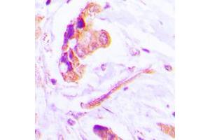 Immunohistochemical analysis of Caspase 3 p17 staining in human lung cancer formalin fixed paraffin embedded tissue section. (Caspase 3 p17 (Center) 抗体)