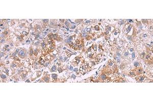 Immunohistochemistry of paraffin-embedded Human liver cancer tissue using GSTCD Polyclonal Antibody at dilution of 1:70(x200) (GSTCD 抗体)