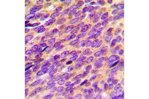 Immunohistochemical analysis of ORAOV1 staining in human breast cancer formalin fixed paraffin embedded tissue section. (ORAOV1 抗体  (Center))