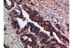 Immunohistochemical analysis of paraffin-embedded human-colon-cancer, antibody was diluted at 1:200 (CTNND1 抗体  (AA 841-890))