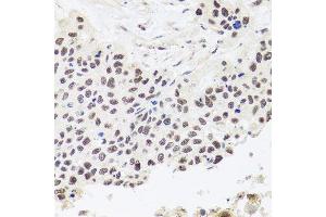 Immunohistochemistry of paraffin-embedded human lung cancer using RPP30 antibody. (RPP30 抗体  (AA 1-268))