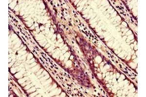 Immunohistochemistry of paraffin-embedded human colon cancer using ABIN7161824 at dilution of 1:100 (NUP85 抗体  (AA 201-500))