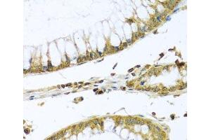 Immunohistochemistry of paraffin-embedded Human colon carcinoma using PMPCB Polyclonal Antibody at dilution of 1:100 (40x lens). (PMPCB 抗体)