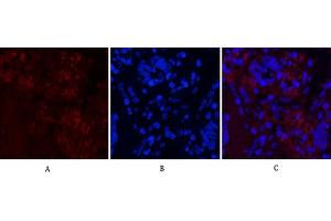 Immunofluorescence analysis of human lung cancer tissue. (Notch1 抗体  (Cleaved-Val1754))