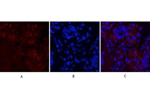 Immunofluorescence analysis of human lung cancer tissue. (Notch1 抗体  (Cleaved-Val1754))