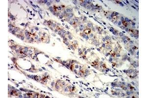Immunohistochemical analysis of paraffin-embedded liver cancer tissues using GPC3 mouse mAb with DAB staining. (Glypican 3 抗体  (AA 359-554))